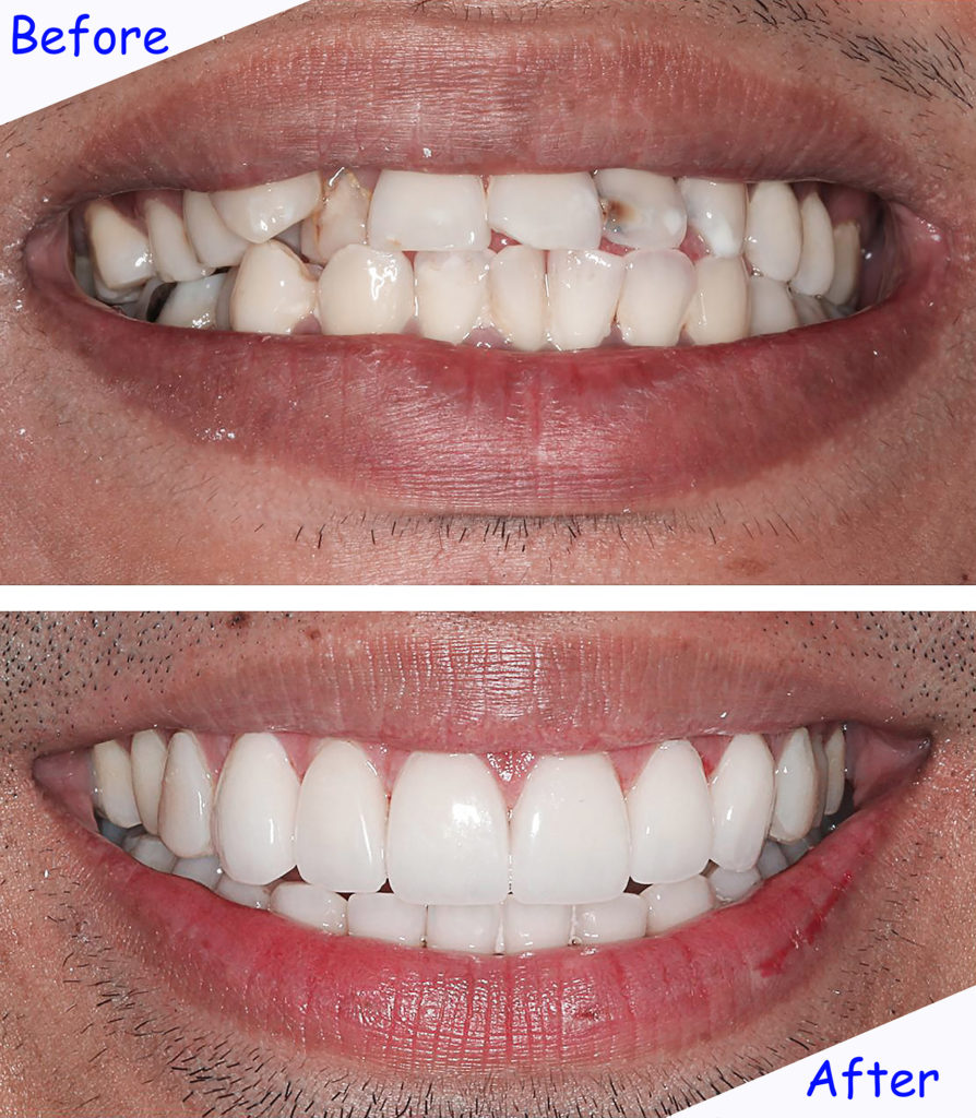 Differences of Crowns & Veneers? Orange, CA Dr Christopher J Fotinos