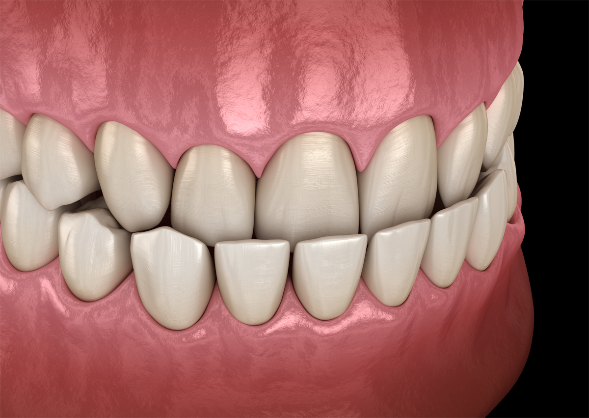 Gingivectomy & Gingivoplasty at Orange CA
