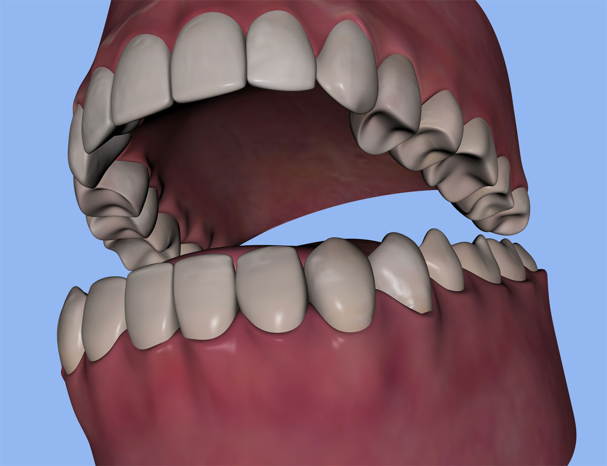 Gingivectomy & Gingivoplasty Orange, CA Dr Christopher J Fotinos