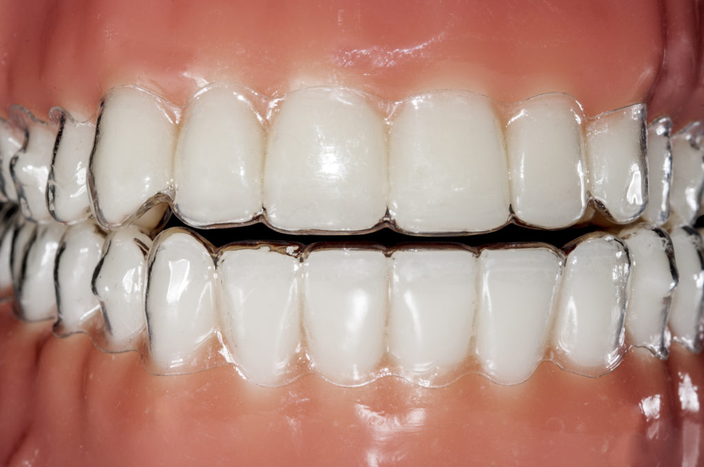 How Do Clear Braces Differ From Traditional Braces?