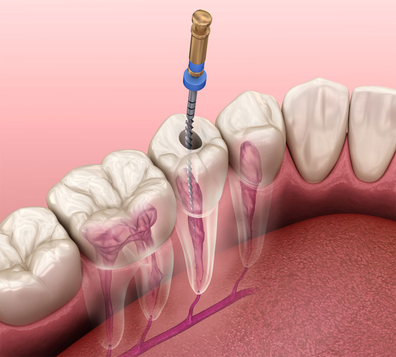 Root Canal Therapy​ Dr. Fortinos at Orange California