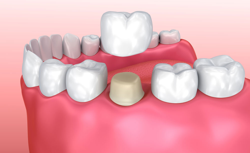 Best Dentist for Cosmetic Crowns at Orange California