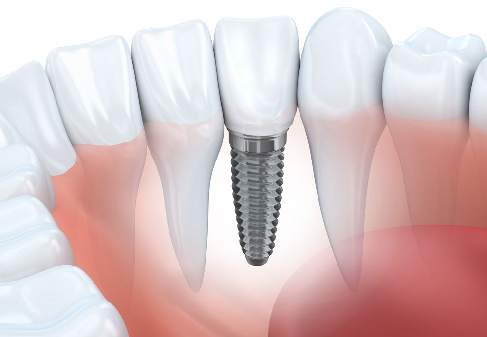 Dental Implants in Orange