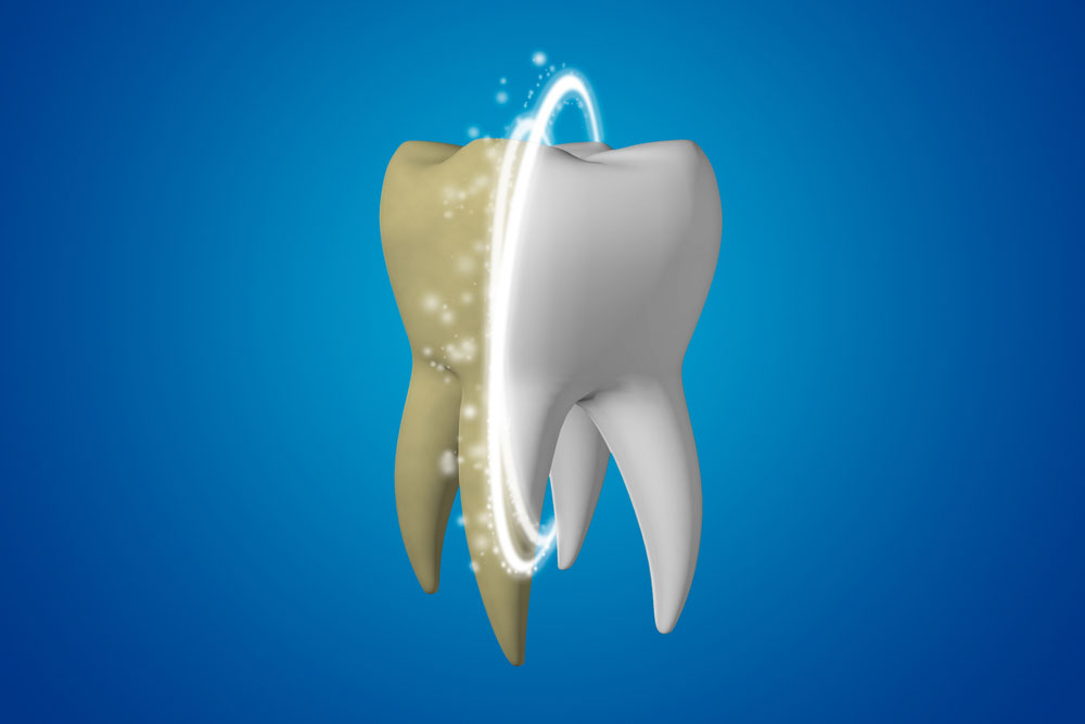 Teeth Whitening Treatments Dr. Fortinos at Orange California