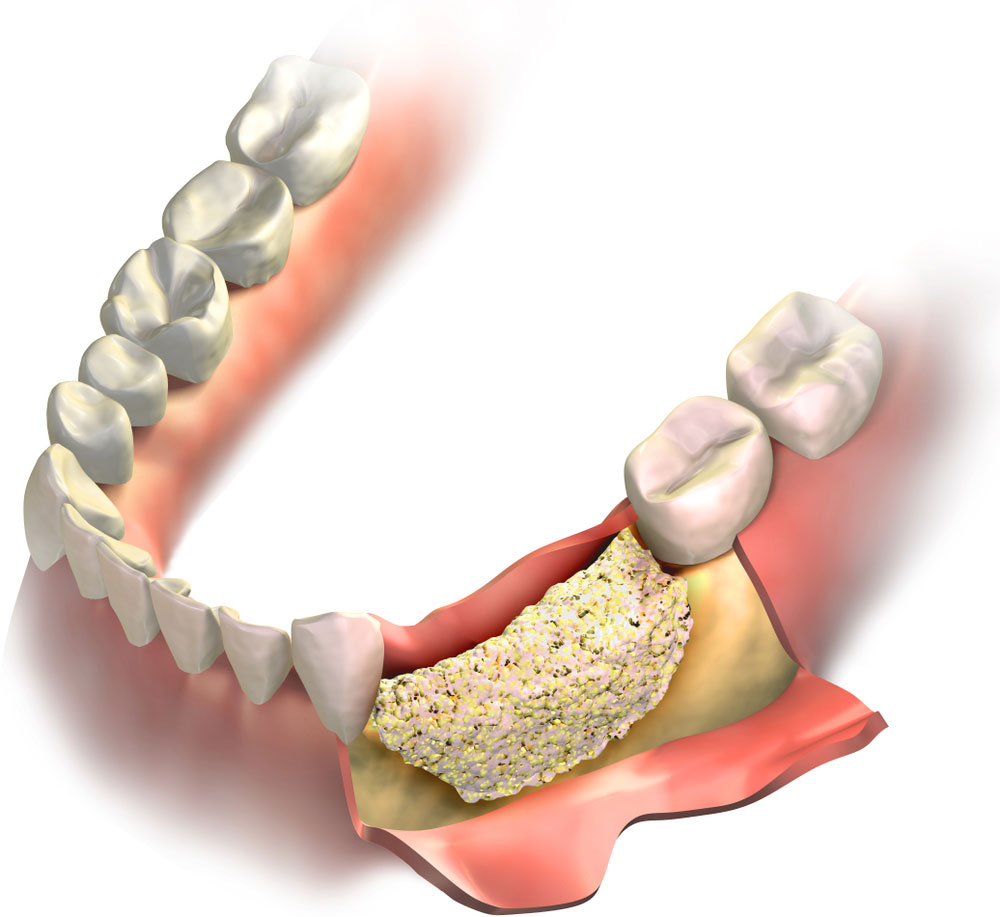 Bone Grafting Dr. Fortinos at Orange California