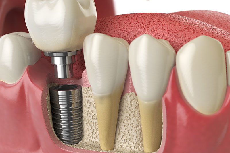 dental-implants_strip1
