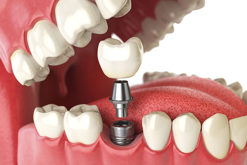 dental-implants_strip2