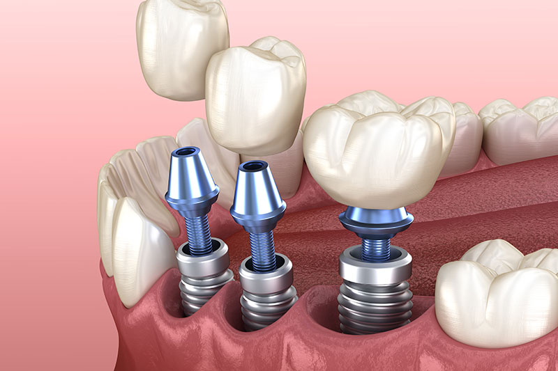 dental-implants_strip3