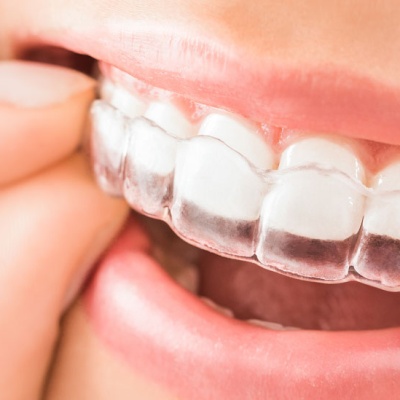 thinking-about-straightening-your-teeth-what-you-should-know-about-invisalign-banner