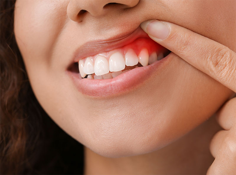 gum-disease-awareness-month-signs-symptoms-of-gum-disease-strip1