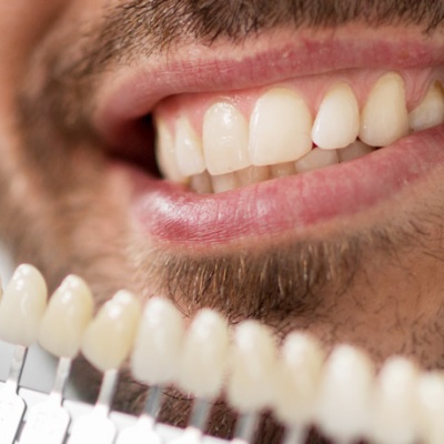unveiling-the-brightest-smile-diy-teeth-whitening-facts-banner